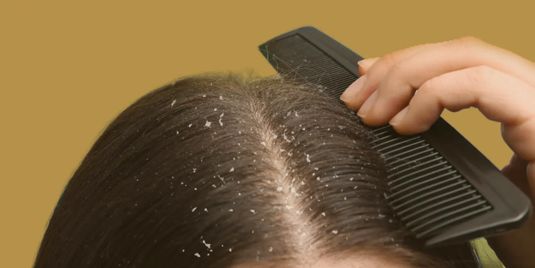 dandruff treatment